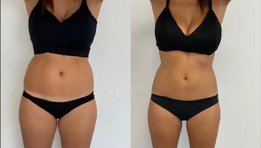 Utiliser la cryolipolyse pour raffermir le ventre à Goderville 